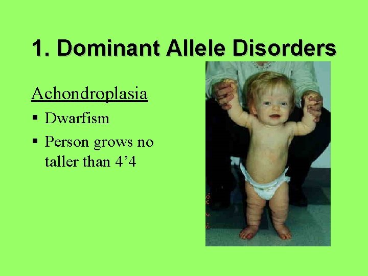 1. Dominant Allele Disorders Achondroplasia § Dwarfism § Person grows no taller than 4’