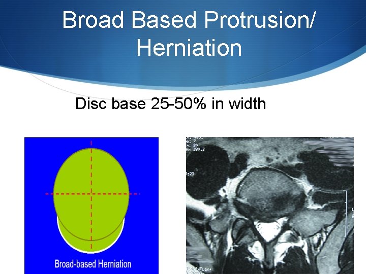 Broad Based Protrusion/ Herniation Disc base 25 -50% in width 