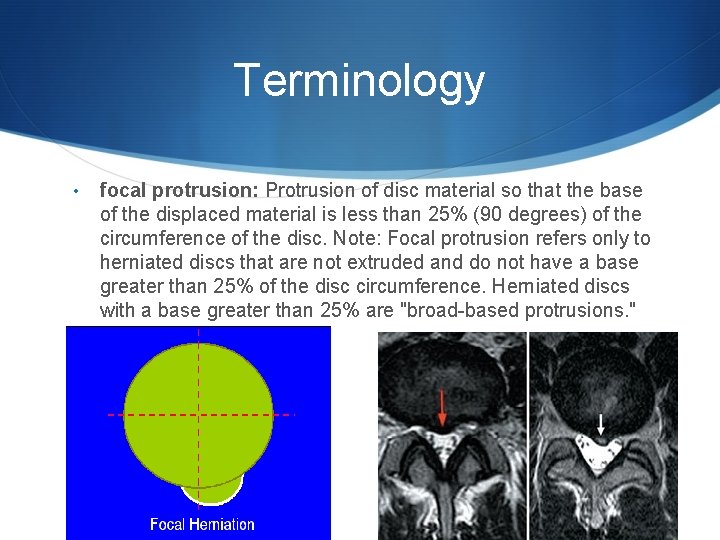 Terminology • focal protrusion: Protrusion of disc material so that the base of the