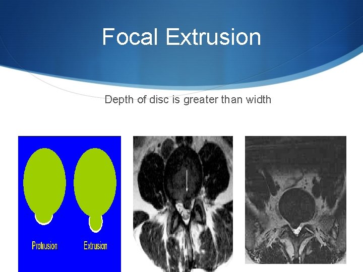 Focal Extrusion Depth of disc is greater than width 