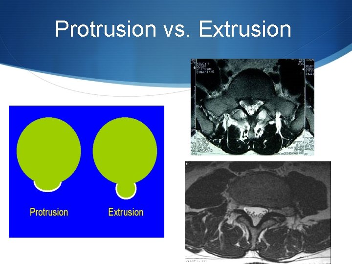 Protrusion vs. Extrusion 