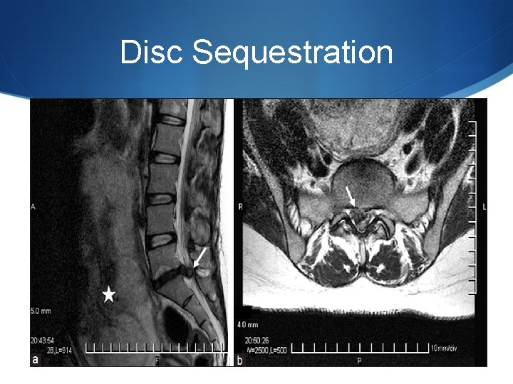 Disc Sequestration 