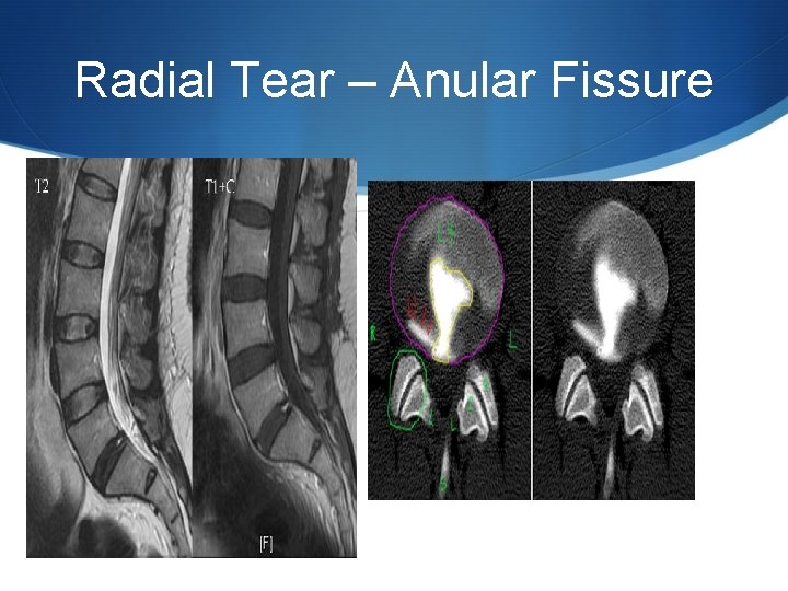 Radial Tear – Anular Fissure 