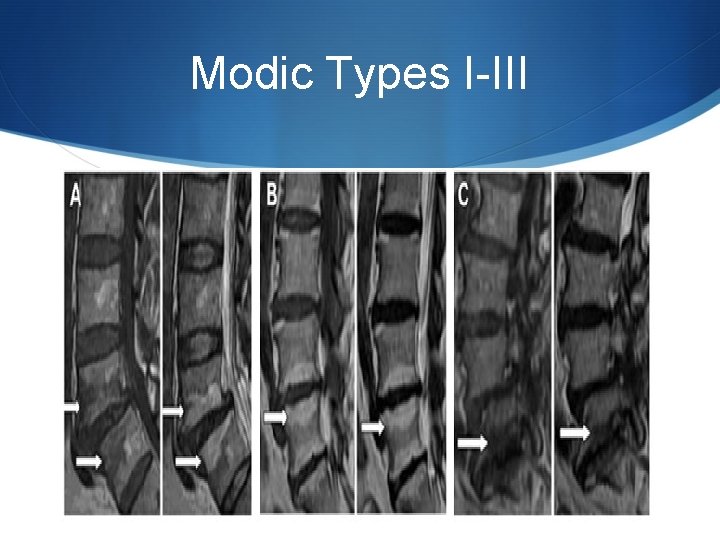 Modic Types I-III 