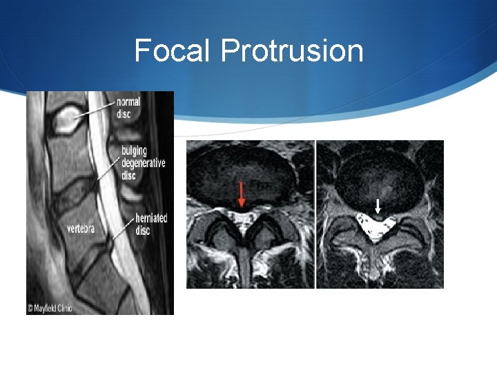 Focal Protrusion 