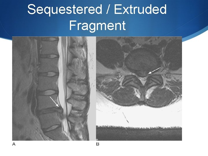 Sequestered / Extruded Fragment 