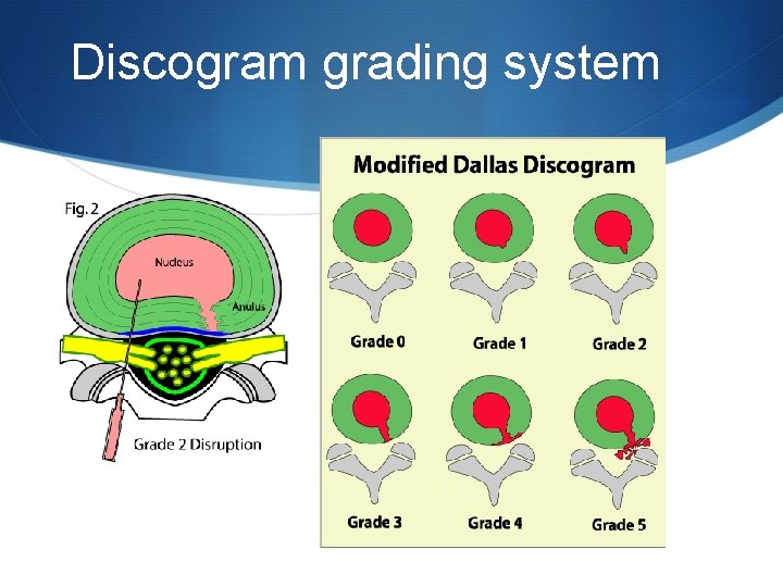 Discogram grading system 