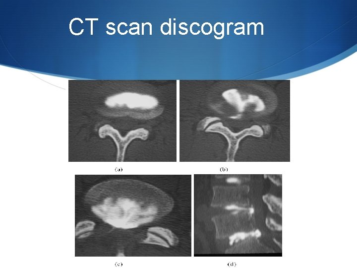 CT scan discogram 