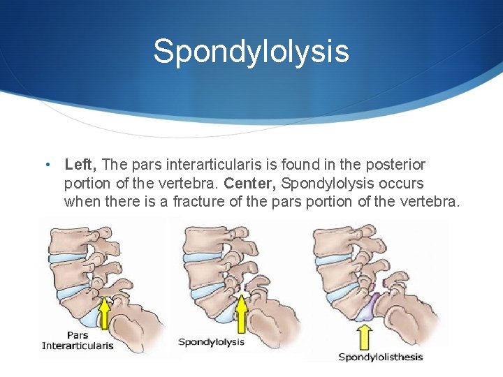 Spondylolysis • Left, The pars interarticularis is found in the posterior portion of the