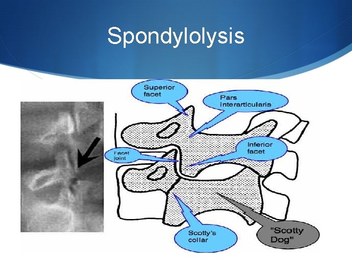 Spondylolysis 