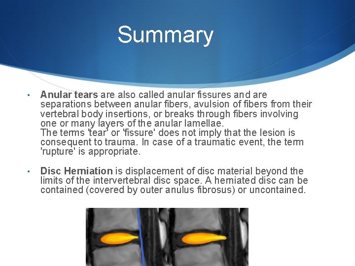 Summary • Anular tears are also called anular fissures and are separations between anular