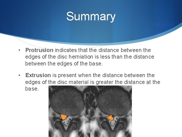 Summary • Protrusion indicates that the distance between the edges of the disc herniation