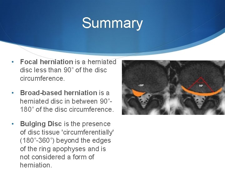 Summary • Focal herniation is a herniated disc less than 90˚ of the disc
