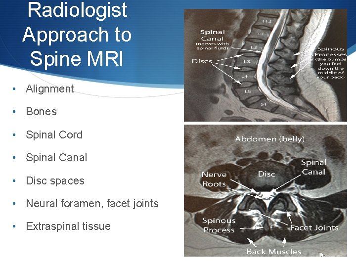 Radiologist Approach to Spine MRI • Alignment • Bones • Spinal Cord • Spinal