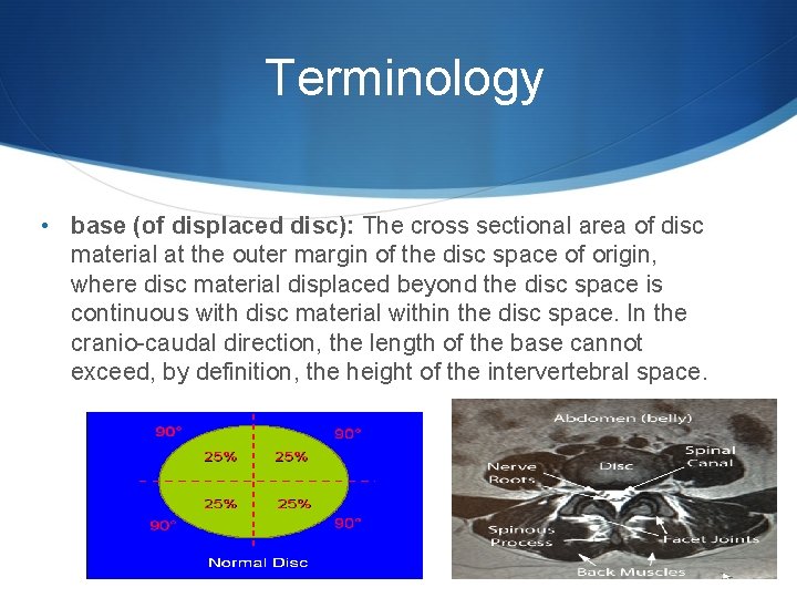 Terminology • base (of displaced disc): The cross sectional area of disc material at