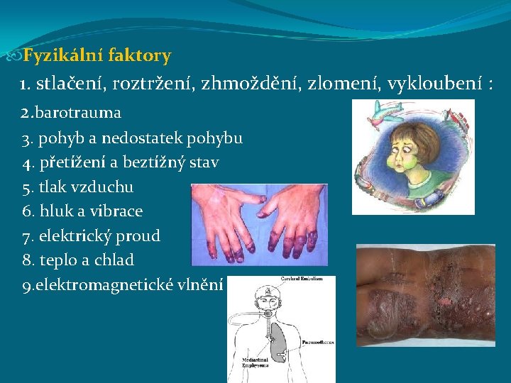  Fyzikální faktory 1. stlačení, roztržení, zhmoždění, zlomení, vykloubení : 2. barotrauma 3. pohyb