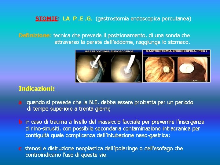 STOMIE: LA P. E. G. (gastrostomia endoscopica percutanea) Definizione: tecnica che prevede il posizionamento,