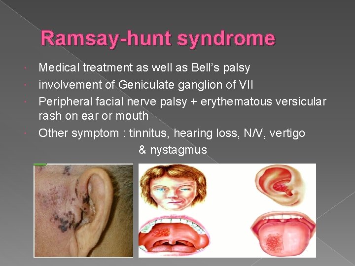 Ramsay-hunt syndrome Medical treatment as well as Bell’s palsy involvement of Geniculate ganglion of