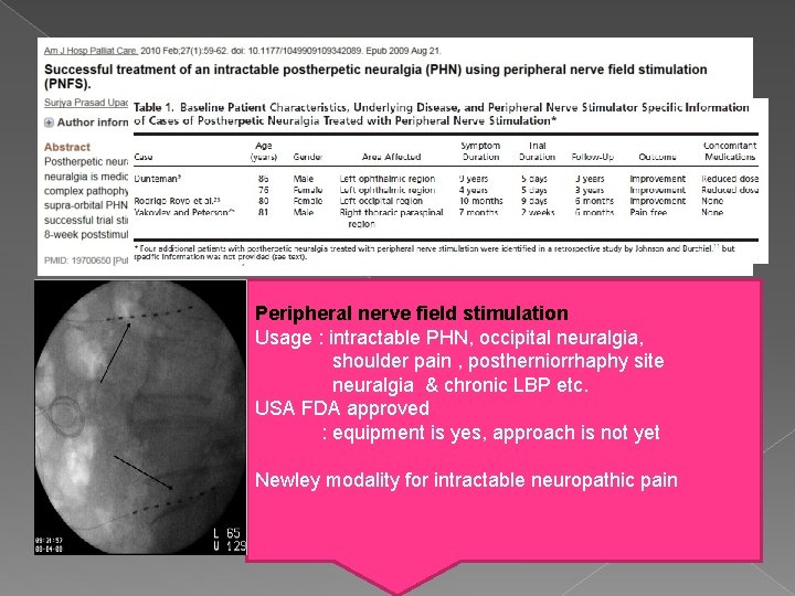 Peripheral nerve field stimulation Usage : intractable PHN, occipital neuralgia, shoulder pain , postherniorrhaphy