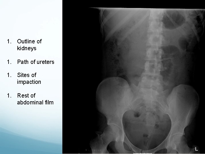 1. Outline of kidneys 1. Path of ureters 1. Sites of impaction 1. Rest
