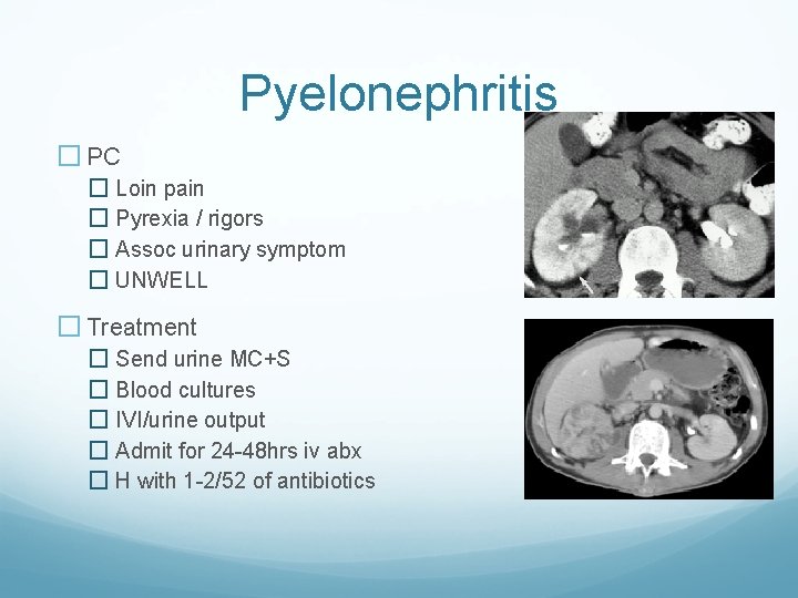 Pyelonephritis � PC � Loin pain � Pyrexia / rigors � Assoc urinary symptom