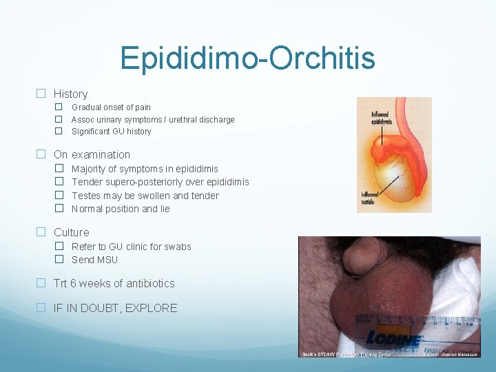 Epididimo-Orchitis � History � Gradual onset of pain � Assoc urinary symptoms / urethral