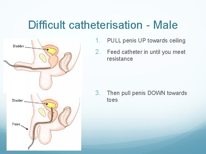 Difficult catheterisation - Male 1. PULL penis UP towards ceiling 2. Feed catheter in