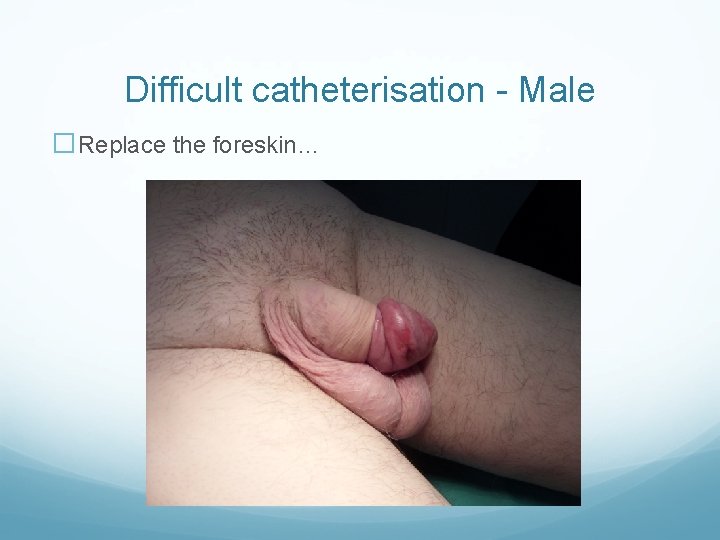Difficult catheterisation - Male �Replace the foreskin… 