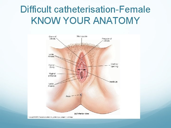 Difficult catheterisation-Female KNOW YOUR ANATOMY 