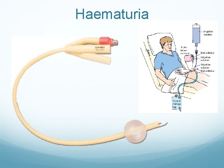 Haematuria 