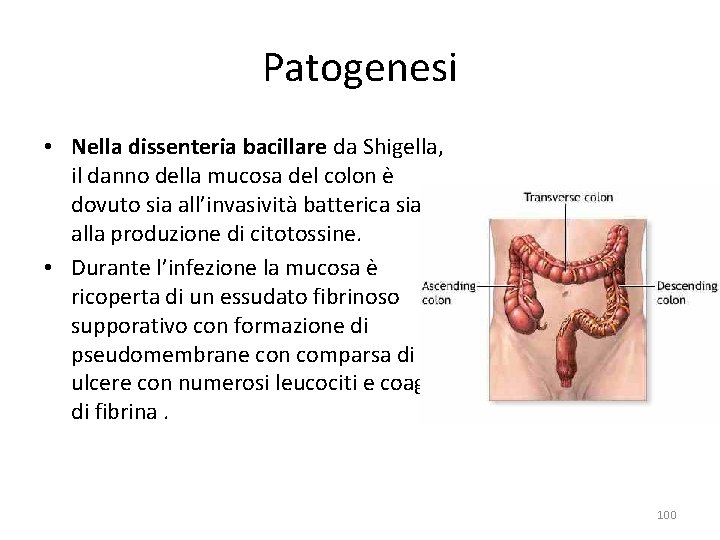 Patogenesi • Nella dissenteria bacillare da Shigella, il danno della mucosa del colon è Patogenesi • Nella dissenteria bacillare da Shigella, il danno della mucosa del colon è