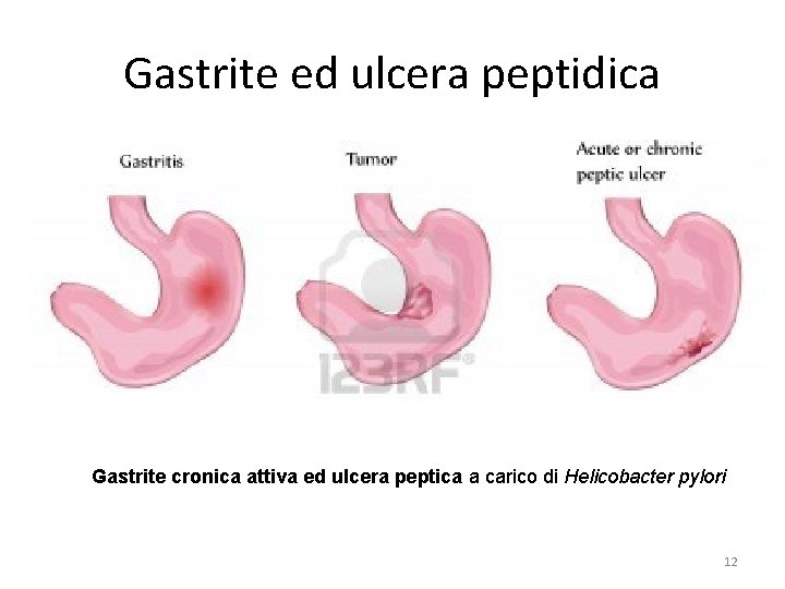 Gastrite ed ulcera peptidica Gastrite cronica attiva ed ulcera peptica a carico di Helicobacter Gastrite ed ulcera peptidica Gastrite cronica attiva ed ulcera peptica a carico di Helicobacter