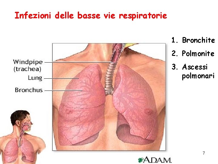 Infezioni delle basse vie respiratorie 1. Bronchite 2. Polmonite 3. Ascessi polmonari 7 
