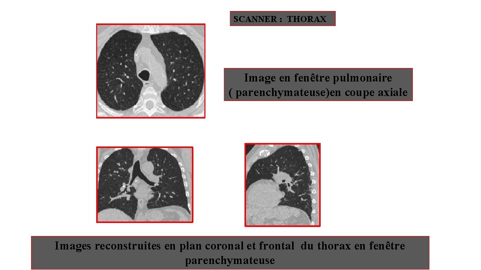 SCANNER : THORAX Image en fenêtre pulmonaire ( parenchymateuse)en coupe axiale Images reconstruites en SCANNER : THORAX Image en fenêtre pulmonaire ( parenchymateuse)en coupe axiale Images reconstruites en
