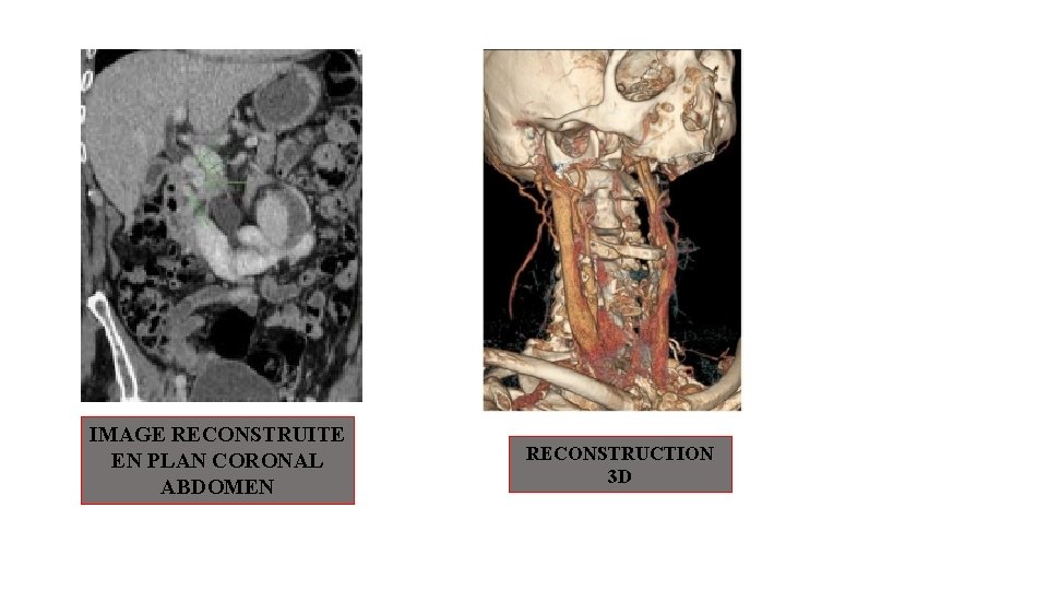 IMAGE RECONSTRUITE EN PLAN CORONAL ABDOMEN RECONSTRUCTION 3 D IMAGE RECONSTRUITE EN PLAN CORONAL ABDOMEN RECONSTRUCTION 3 D