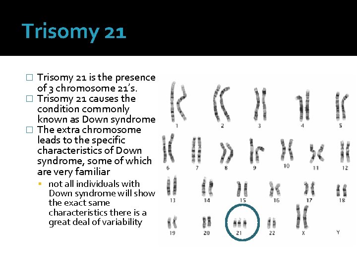 Trisomy 21 is the presence of 3 chromosome 21’s. � Trisomy 21 causes the