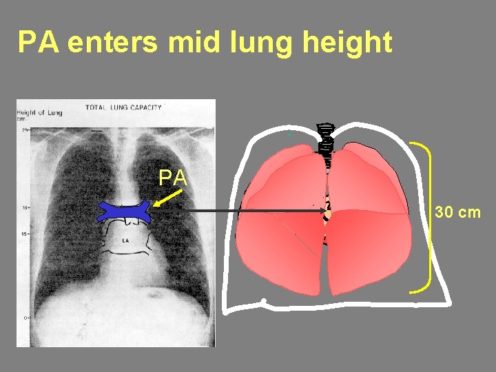 PA enters mid lung height PA 30 cm 