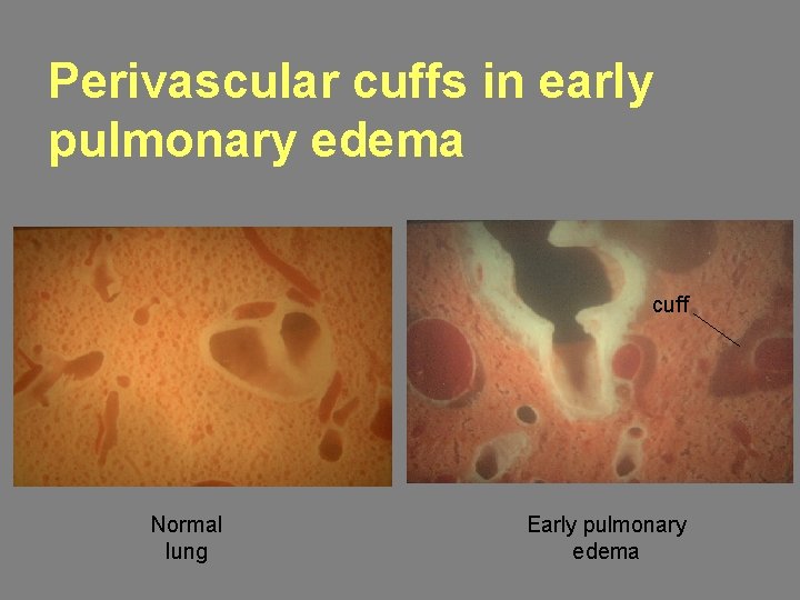 Perivascular cuffs in early pulmonary edema cuff Normal lung Early pulmonary edema 