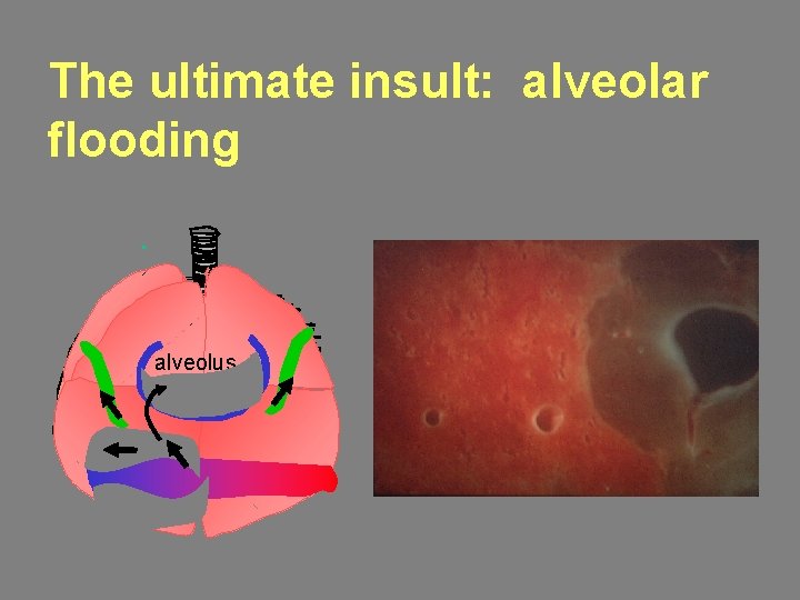 The ultimate insult: alveolar flooding alveolus 