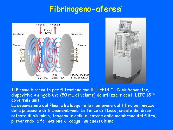 Fibrinogeno-aferesi Il Plasma è raccolto per filtrazione con il LIFE 18™ - Disk Separator,