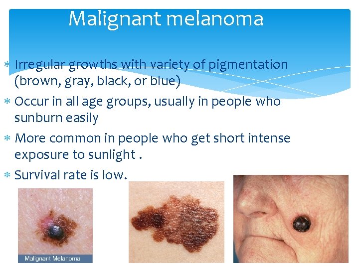 Malignant melanoma Irregular growths with variety of pigmentation (brown, gray, black, or blue) Occur