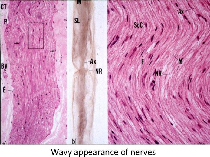 Wavy appearance of nerves 