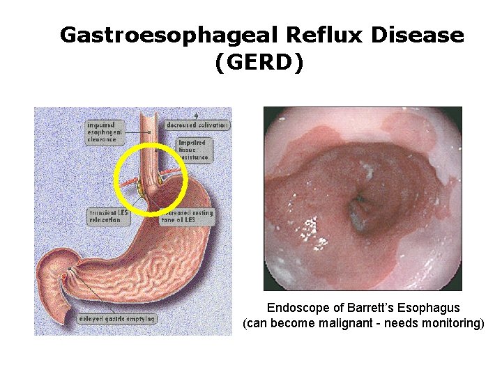 Gastroesophageal Reflux Disease (GERD) Endoscope of Barrett’s Esophagus (can become malignant - needs monitoring)