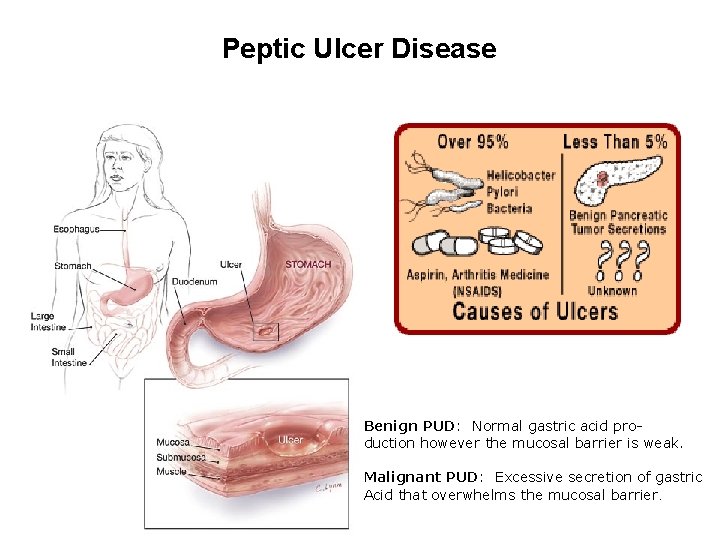 Peptic Ulcer Disease Benign PUD: Normal gastric acid production however the mucosal barrier is