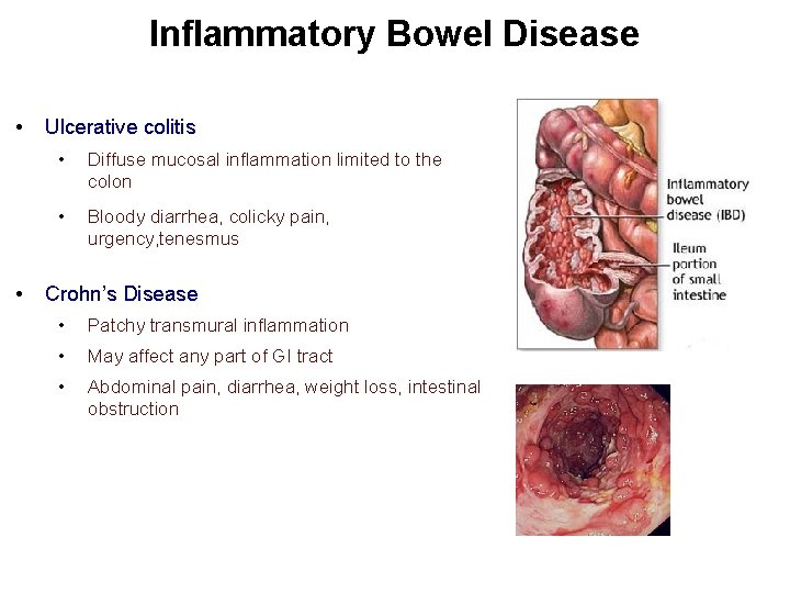 Inflammatory Bowel Disease • • Ulcerative colitis • Diffuse mucosal inflammation limited to the