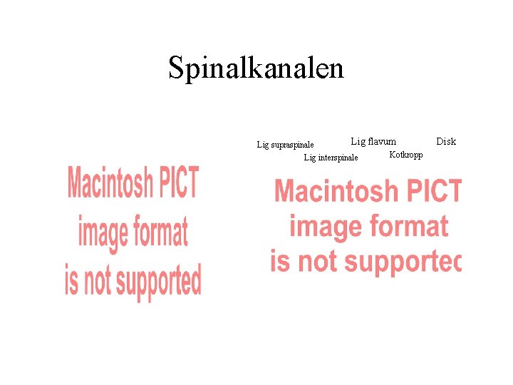 Spinalkanalen Lig flavum Lig supraspinale Kotkropp Lig interspinale Disk 