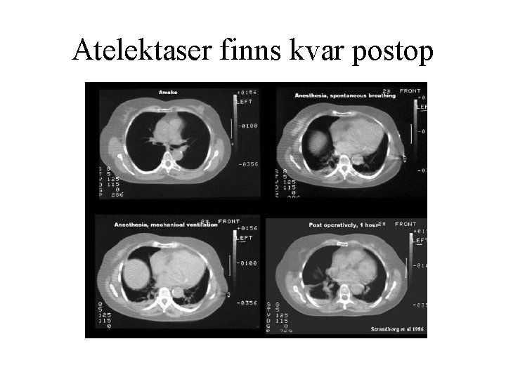 Atelektaser finns kvar postop 