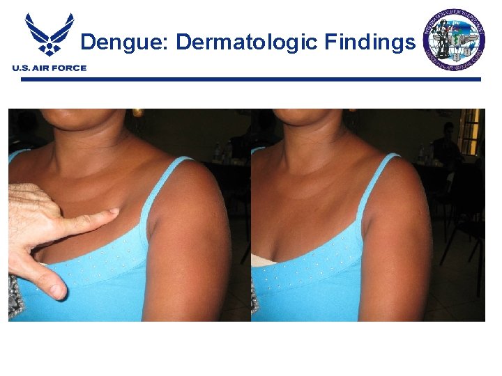 Dengue: Dermatologic Findings Dengue: Dermatologic Findings