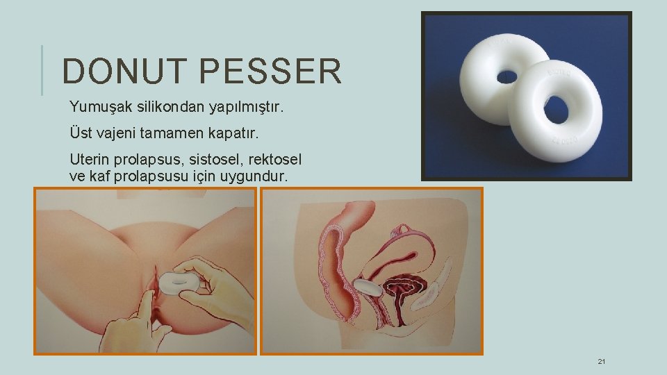 DONUT PESSER Yumuşak silikondan yapılmıştır. Üst vajeni tamamen kapatır. Uterin prolapsus, sistosel, rektosel ve