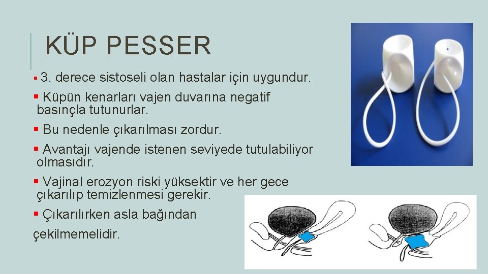 KÜP PESSER § 3. derece sistoseli olan hastalar için uygundur. § Küpün kenarları vajen